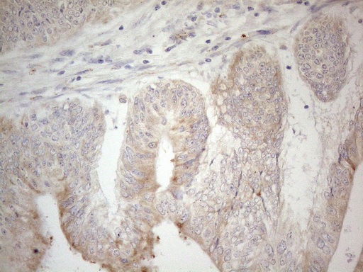 PDX1 Antibody - Immunohistochemical staining of paraffin-embedded Adenocarcinoma of Human colon tissue using anti-PDX1 mouse monoclonal antibody. (Heat-induced epitope retrieval by 1mM EDTA in 10mM Tris buffer. (pH8.5) at 120°C for 3 min. (1:150)