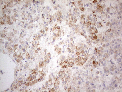 PDX1 Antibody - Immunohistochemical staining of paraffin-embedded Human liver tissue using anti-PDX1 mouse monoclonal antibody. (Heat-induced epitope retrieval by 1mM EDTA in 10mM Tris buffer. (pH8.5) at 120°C for 3 min. (1:150)