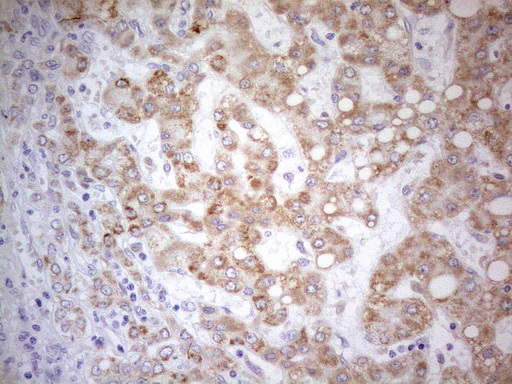 PDX1 Antibody - Immunohistochemical staining of paraffin-embedded Carcinoma of Human liver tissue using anti-PDX1 mouse monoclonal antibody. (Heat-induced epitope retrieval by 1mM EDTA in 10mM Tris buffer. (pH8.5) at 120°C for 3 min. (1:150)