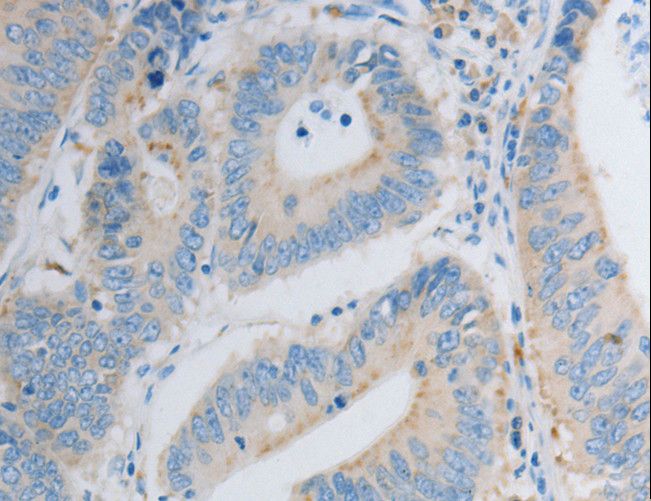 PDX1 Antibody - Immunohistochemistry of paraffin-embedded Human colon cancer using PDX1 Polyclonal Antibody at dilution of 1:30.