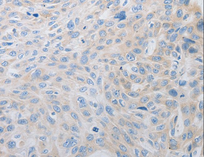 PDX1 Antibody - Immunohistochemistry of paraffin-embedded Human esophagus cancer using PDX1 Polyclonal Antibody at dilution of 1:30.