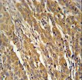 PDXDC1 Antibody - PDXD1 Antibody immunohistochemistry of formalin-fixed and paraffin-embedded human cervix carcinoma followed by peroxidase-conjugated secondary antibody and DAB staining.