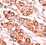 PDXK / PNK Antibody - Formalin-fixed and paraffin-embedded human cancer tissue reacted with the primary antibody, which was peroxidase-conjugated to the secondary antibody, followed by DAB staining. This data demonstrates the use of this antibody for immunohistochemistry; clinical relevance has not been evaluated. BC = breast carcinoma; HC = hepatocarcinoma.