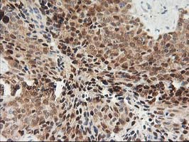 PDXK / PNK Antibody - IHC of paraffin-embedded Adenocarcinoma of Human breast tissue using anti-PDXK mouse monoclonal antibody.