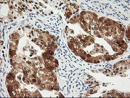 PDXK / PNK Antibody - IHC of paraffin-embedded Adenocarcinoma of Human ovary tissue using anti-PDXK mouse monoclonal antibody.