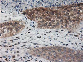 PDXK / PNK Antibody - IHC of paraffin-embedded Carcinoma of Human bladder tissue using anti-PDXK mouse monoclonal antibody.