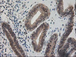 PDXK / PNK Antibody - IHC of paraffin-embedded Adenocarcinoma of Human endometrium tissue using anti-PDXK mouse monoclonal antibody.