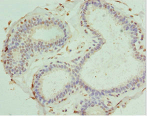 PDXK / PNK Antibody - Immunohistochemistry of paraffin-embedded human breast cancer at dilution 1:100