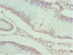 PDXK / PNK Antibody - Immunohistochemistry of paraffin-embedded human colon cancer at dilution 1:100
