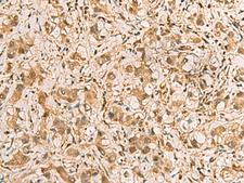 PDXK / PNK Antibody - Immunohistochemistry of paraffin-embedded Human liver cancer tissue  using PDXK Polyclonal Antibody at dilution of 1:75(×200)
