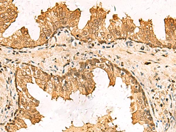 PDXK / PNK Antibody - Immunohistochemistry of paraffin-embedded Human prost at e cancer tissue  using PDXK Polyclonal Antibody at dilution of 1:75(×200)