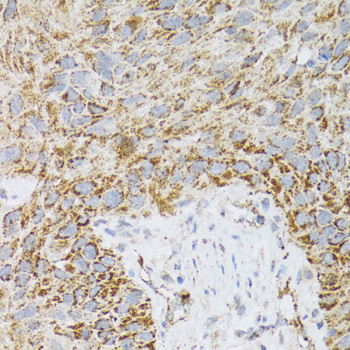 PDYN / ProDynorphin Antibody - Immunohistochemistry of paraffin-embedded human lung cancer tissue.