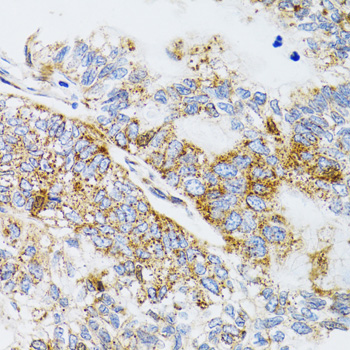 PDYN / ProDynorphin Antibody - Immunohistochemistry of paraffin-embedded human gastric cancer tissue.