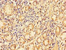 PDZRN3 Antibody - Immunohistochemistry of paraffin-embedded human gastric cancer using PDZRN3 Antibody at dilution of 1:100