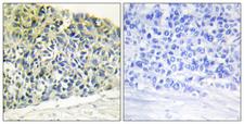 PEA15 / PEA-15 Antibody - P-peptide - + Immunohistochemistry analysis of paraffin-embedded human breast carcinoma tissue using PEA-15 (Phospho-Ser116) antibody.