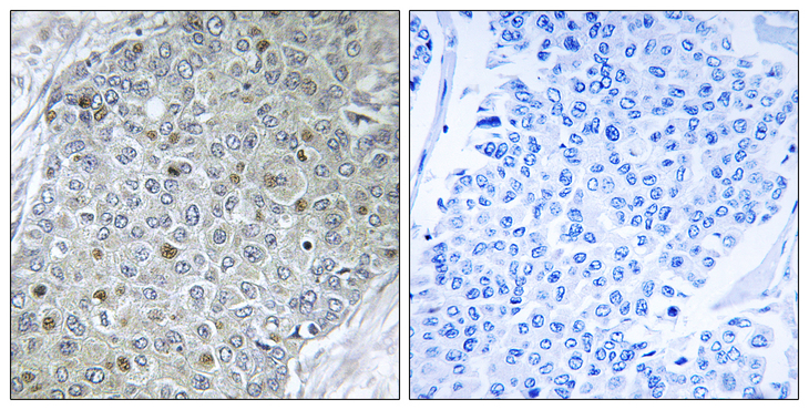 PEA3 / ETV4 Antibody - Immunohistochemistry analysis of paraffin-embedded human breast carcinoma tissue, using ETV4 Antibody. The picture on the right is blocked with the synthesized peptide.