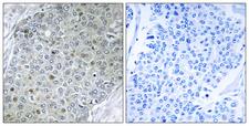 PEA3 / ETV4 Antibody - Immunohistochemistry analysis of paraffin-embedded human breast carcinoma tissue, using ETV4 Antibody. The picture on the right is blocked with the synthesized peptide.
