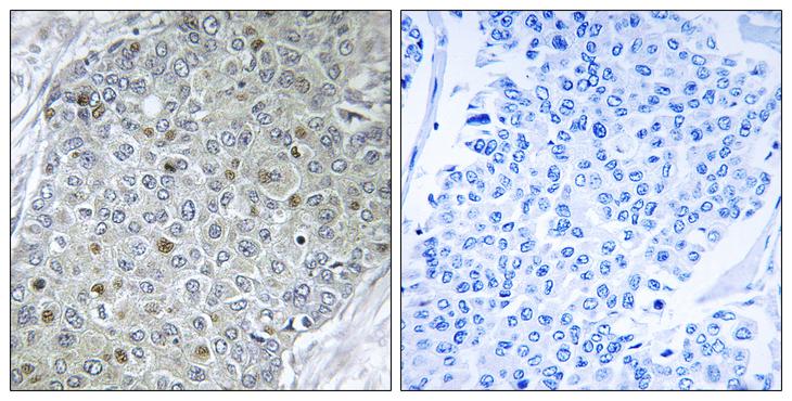 PEA3 / ETV4 Antibody - Peptide - + Immunohistochemistry analysis of paraffin-embedded human breast carcinoma tissue, using ETV4 antibody.