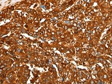 PEAR1 Antibody - Immunohistochemistry of paraffin-embedded Human liver cancer tissue  using PEAR1 Polyclonal Antibody at dilution of 1:25(×200)