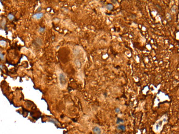PEAR1 Antibody - Immunohistochemistry of paraffin-embedded Human breast cancer tissue  using PEAR1 Polyclonal Antibody at dilution of 1:25(×200)