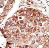 PEBP1 / RKIP Antibody - Formalin-fixed and paraffin-embedded human cancer tissue reacted with the primary antibody, which was peroxidase-conjugated to the secondary antibody, followed by DAB staining. This data demonstrates the use of this antibody for immunohistochemistry; clinical relevance has not been evaluated. BC = breast carcinoma; HC = hepatocarcinoma.