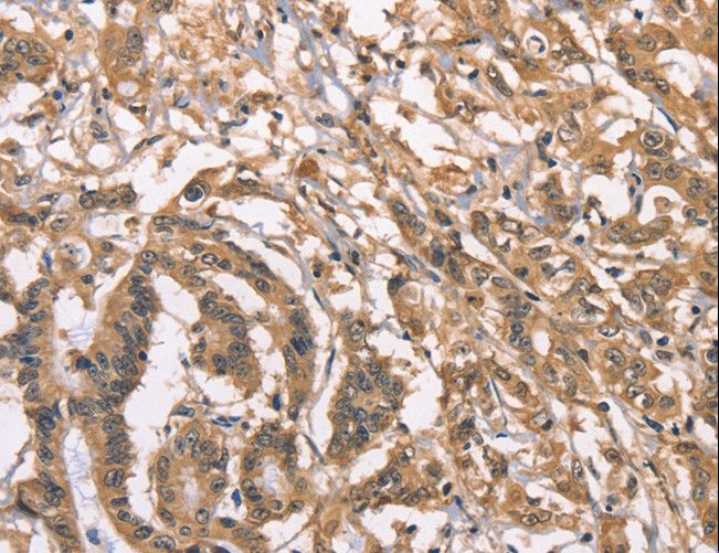 PEBP1 / RKIP Antibody - Immunohistochemistry of paraffin-embedded Human colon cancer using PEBP1 Polyclonal Antibody at dilution of 1:40.