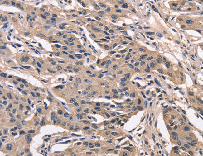 PEBP1 / RKIP Antibody - Immunohistochemistry of paraffin-embedded Human lung cancer using PEBP1 Polyclonal Antibody at dilution of 1:40.