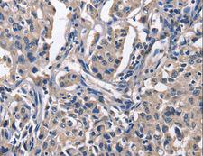 PEBP1 / RKIP Antibody - Immunohistochemistry of paraffin-embedded Human lung cancer using PEBP1 Polyclonal Antibody at dilution of 1:50.