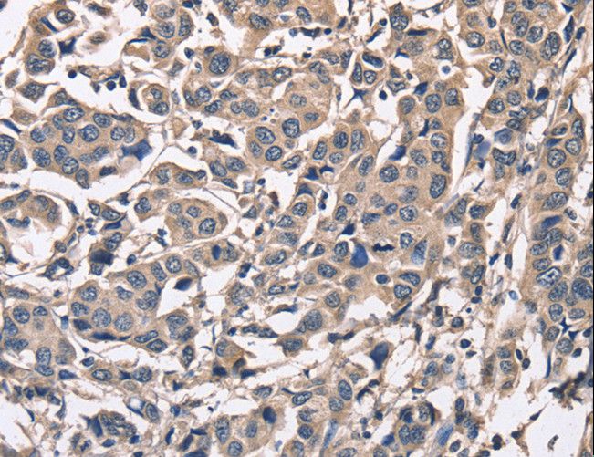 PEBP1 / RKIP Antibody - Immunohistochemistry of paraffin-embedded Human breast cancer using PEBP1 Polyclonal Antibody at dilution of 1:50.