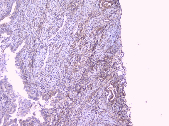 PEBP1 / RKIP Antibody - IHC analysis of PBP using anti-PBP antibody. PBP was detected in paraffin-embedded section of human intestinal cancer tissue. Heat mediated antigen retrieval was performed in citrate buffer (pH6, epitope retrieval solution) for 20 mins. The tissue section was blocked with 10% goat serum. The tissue section was then incubated with 1µg/ml rabbit anti-PBP Antibody overnight at 4°C. Biotinylated goat anti-rabbit IgG was used as secondary antibody and incubated for 30 minutes at 37°C. The tissue section was developed using Strepavidin-Biotin-Complex (SABC) with DAB as the chromogen.