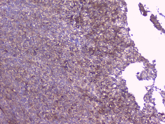 PEBP1 / RKIP Antibody - IHC analysis of PBP using anti-PBP antibody. PBP was detected in paraffin-embedded section of human sarcoma tissue. Heat mediated antigen retrieval was performed in citrate buffer (pH6, epitope retrieval solution) for 20 mins. The tissue section was blocked with 10% goat serum. The tissue section was then incubated with 1µg/ml rabbit anti-PBP Antibody overnight at 4°C. Biotinylated goat anti-rabbit IgG was used as secondary antibody and incubated for 30 minutes at 37°C. The tissue section was developed using Strepavidin-Biotin-Complex (SABC) with DAB as the chromogen.