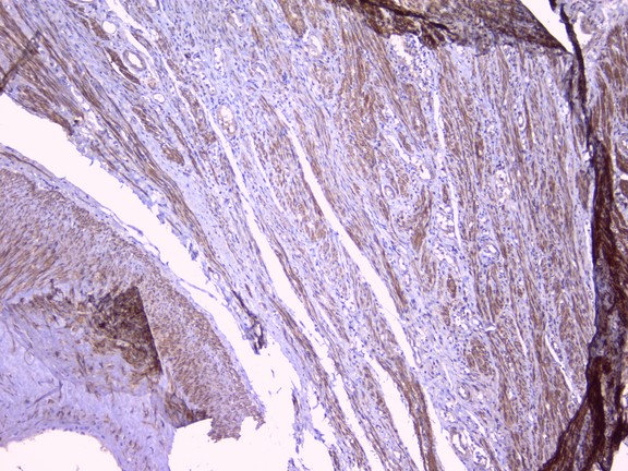 PEBP1 / RKIP Antibody - IHC analysis of PBP using anti-PBP antibody. PBP was detected in paraffin-embedded section of human endometrial carcinoma tissue. Heat mediated antigen retrieval was performed in citrate buffer (pH6, epitope retrieval solution) for 20 mins. The tissue section was blocked with 10% goat serum. The tissue section was then incubated with 1µg/ml rabbit anti-PBP Antibody overnight at 4°C. Biotinylated goat anti-rabbit IgG was used as secondary antibody and incubated for 30 minutes at 37°C. The tissue section was developed using Strepavidin-Biotin-Complex (SABC) with DAB as the chromogen.