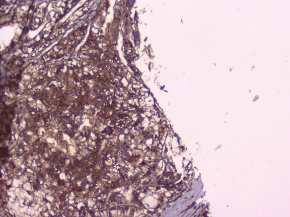 PEBP1 / RKIP Antibody - IHC analysis of PBP using anti-PBP antibody. PBP was detected in paraffin-embedded section of human liver cancer tissue. Heat mediated antigen retrieval was performed in citrate buffer (pH6, epitope retrieval solution) for 20 mins. The tissue section was blocked with 10% goat serum. The tissue section was then incubated with 1µg/ml rabbit anti-PBP Antibody overnight at 4°C. Biotinylated goat anti-rabbit IgG was used as secondary antibody and incubated for 30 minutes at 37°C. The tissue section was developed using Strepavidin-Biotin-Complex (SABC) with DAB as the chromogen.