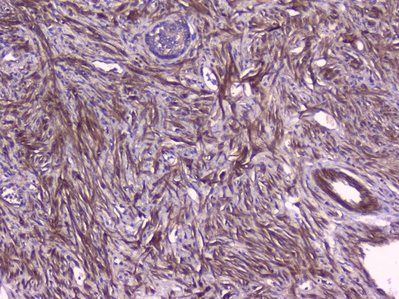 PEBP1 / RKIP Antibody - IHC analysis of PBP using anti-PBP antibody. PBP was detected in paraffin-embedded section of human pancreatic cancer tissue. Heat mediated antigen retrieval was performed in citrate buffer (pH6, epitope retrieval solution) for 20 mins. The tissue section was blocked with 10% goat serum. The tissue section was then incubated with 1µg/ml rabbit anti-PBP Antibody overnight at 4°C. Biotinylated goat anti-rabbit IgG was used as secondary antibody and incubated for 30 minutes at 37°C. The tissue section was developed using Strepavidin-Biotin-Complex (SABC) with DAB as the chromogen.