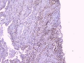 PEBP1 / RKIP Antibody - IHC testing of FFPE human intestinal cancer with RKIP antibody at 1ug/ml. HIER: boil tissue sections in pH6, 10mM citrate buffer, for 10-20 min followed by cooling at RT for 20 min.