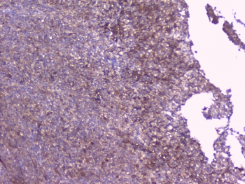 PEBP1 / RKIP Antibody - IHC testing of FFPE human sarcoma with RKIP antibody at 1ug/ml. HIER: boil tissue sections in pH6, 10mM citrate buffer, for 10-20 min followed by cooling at RT for 20 min.
