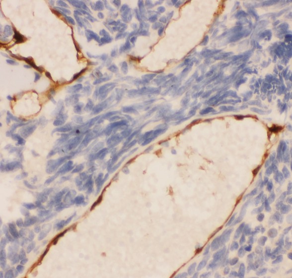 PECAM-1 / CD31 Antibody - CD31 antibody IHC-paraffin: Human Lung Cancer Tissue.