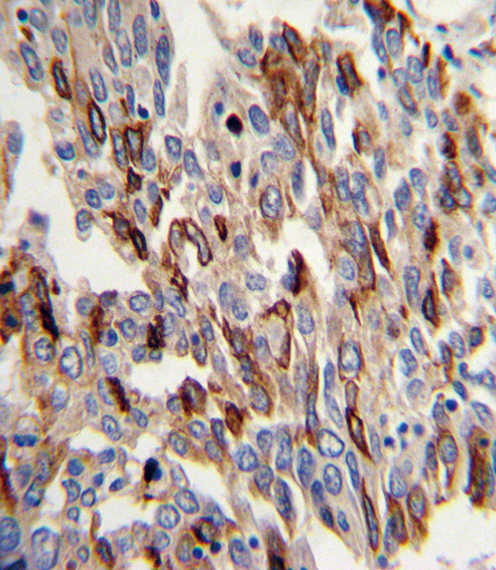 PECAM-1 / CD31 Antibody - Formalin-fixed and paraffin-embedded human lung carcinoma with CD31 Antibody , which was peroxidase-conjugated to the secondary antibody, followed by DAB staining. This data demonstrates the use of this antibody for immunohistochemistry; clinical relevance has not been evaluated.