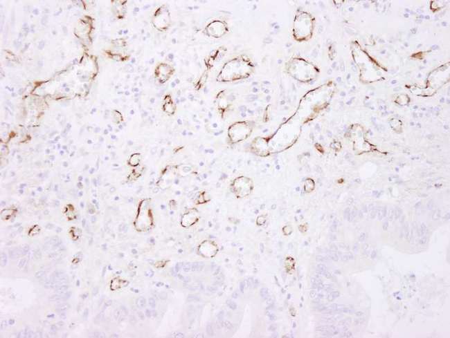 PECAM-1 / CD31 Antibody - Detection of Human CD31 by Immunohistochemistry. Sample: FFPE section of human colon adenocarcinoma. Antibody: Affinity purified rabbit anti-CD31 used at a dilution of 1:250. Detection: DAB.