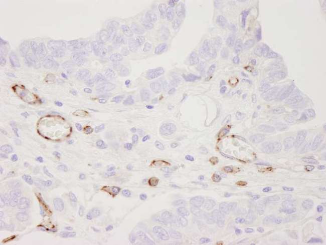 PECAM-1 / CD31 Antibody - Detection of Human CD31 by Immunohistochemistry. Sample: FFPE section of human ovarian carcinoma. Antibody: Affinity purified rabbit anti-CD31 used at a dilution of 1:250. Detection: DAB.