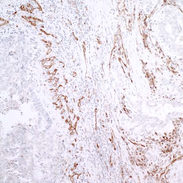 PECAM-1 / CD31 Antibody - Detection of human CD31 by immunohistochemistry. Sample: FFPE section of human lung adenocarcinoma. Antibody: Affinity purified rabbit anti-CD31 used at a dilution of 1:100 with Citrate Epitope Retrieval pH6.0. Detection: DAB