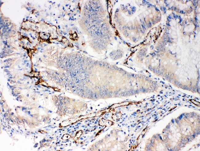 PECAM-1 / CD31 Antibody - CD31 antibody IHC-paraffin: Human Intestinal Cancer Tissue.