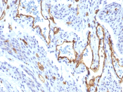 PECAM-1 / CD31 Antibody - Formalin-fixed, paraffin-embedded human Angiosarcoma stained with CD31 Rabbit Recombinant Monoclonal Antibody (C31/1395R).