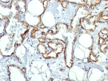 PECAM-1 / CD31 Antibody - Formalin-fixed, paraffin-embedded human angiosarcoma stained with CD31 antibody (C31.10).  This image was taken for the unmodified form of this product. Other forms have not been tested.