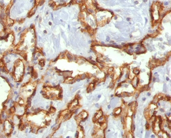 PECAM-1 / CD31 Antibody - CD31 antibody C31.3 immunohistochemistry angiosarcoma.  This image was taken for the unmodified form of this product. Other forms have not been tested.