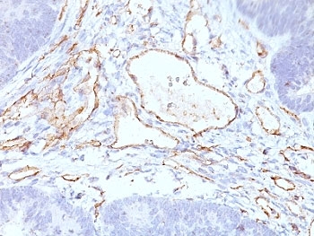 PECAM-1 / CD31 Antibody - Formalin-fixed, paraffin-embedded colon carcinoma stained with CD31 antibody (C31.3+C31.7+C31.10).  This image was taken for the unmodified form of this product. Other forms have not been tested. Done at a concentration of 1-2 ug/ml. 