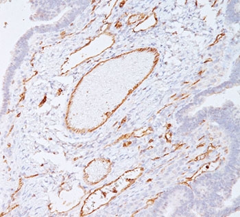 PECAM-1 / CD31 Antibody - PECAM-1 antibody C31.7 immunohistochemistry colon carcinoma.  This image was taken for the unmodified form of this product. Other forms have not been tested.