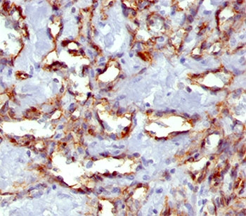 PECAM-1 / CD31 Antibody - PECAM-1 antibody C31.7 immunohistochemistry angiosarcoma.  This image was taken for the unmodified form of this product. Other forms have not been tested.