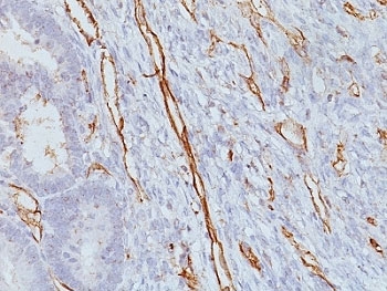PECAM-1 / CD31 Antibody - Formalin-fixed, paraffin-embedded human colon carcinoma stained with CD31 antibody (JC/70A).  This image was taken for the unmodified form of this product. Other forms have not been tested.