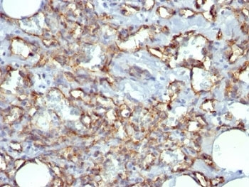 PECAM-1 / CD31 Antibody - Formalin-fixed, paraffin-embedded human Angiosarcoma stained with CD31 antibody (JC/70A).  This image was taken for the unmodified form of this product. Other forms have not been tested.